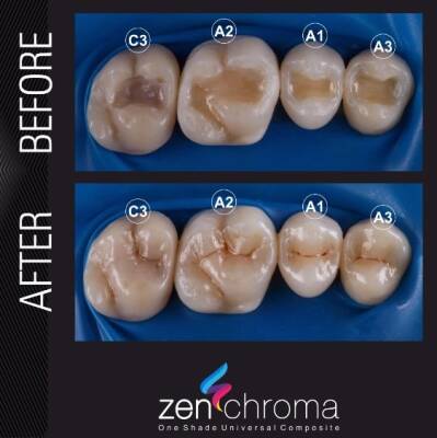 Zen Chroma Kompozit Dolgu 4gr. - 3